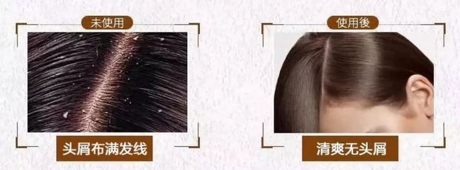 脫發(fā)、掉發(fā)、頭發(fā)稀少？用它洗洗，一次就離不開